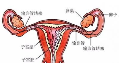 输卵管阻塞何时需要做试管婴儿 